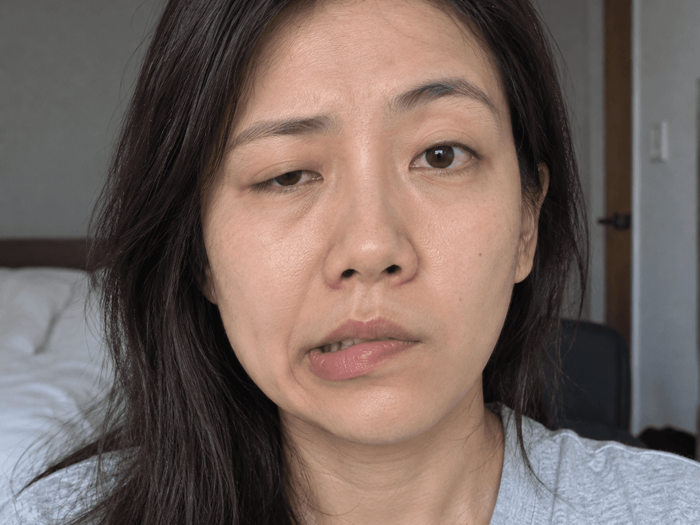 A close-up of a woman's face showing weakness down one side, with the mouth and eyelid drooping