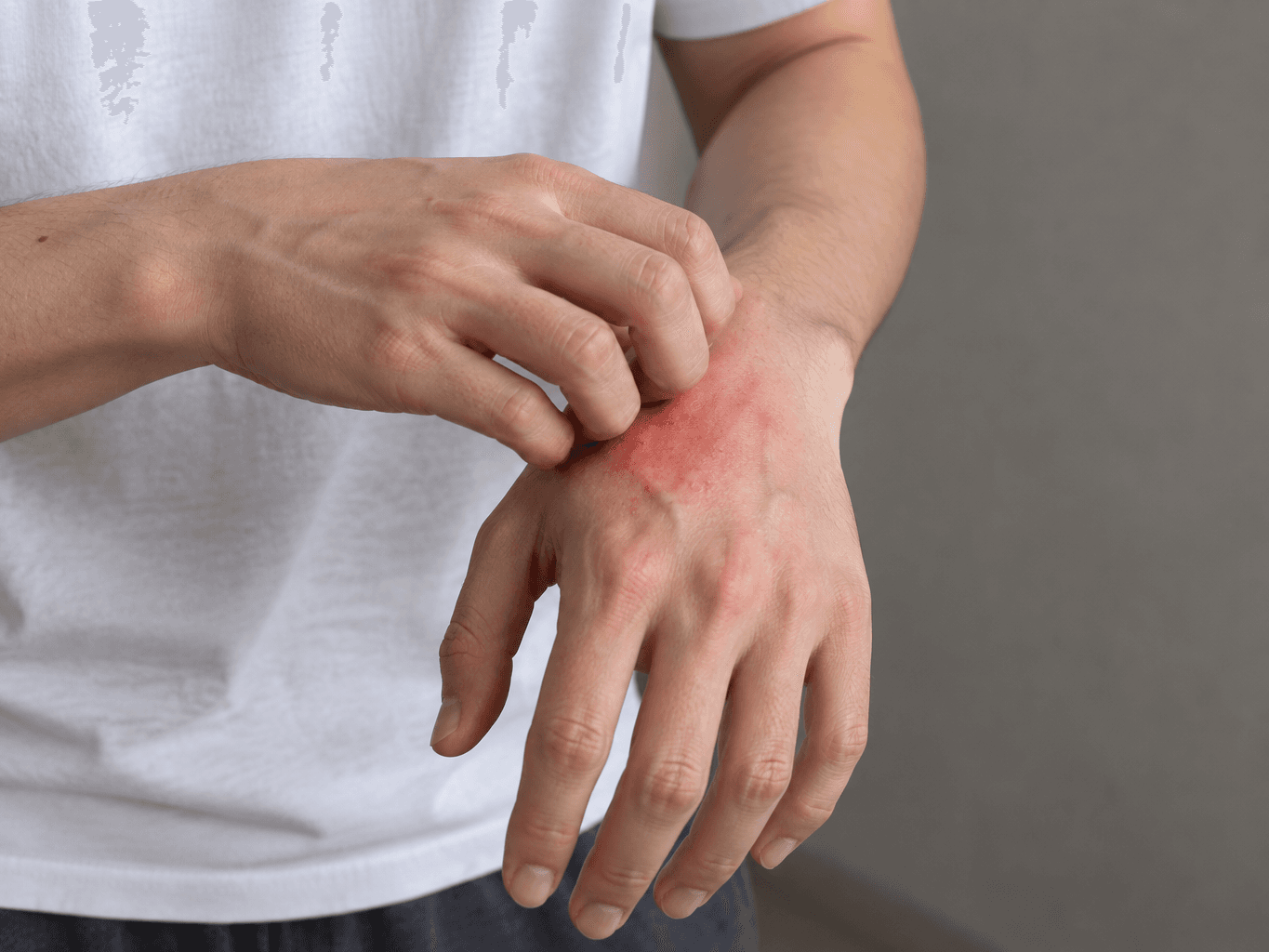 A person scratching a patch of red, inflamed skin on the back of one hand