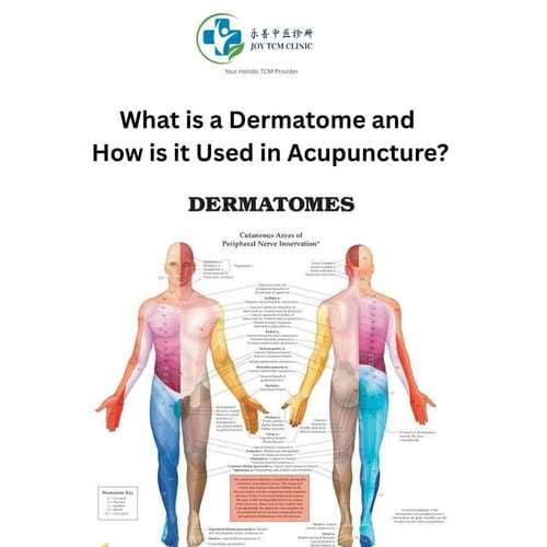 What is a dermatome, and how is it used in acupuncture?